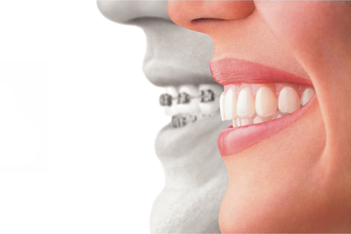 ortodoncia-invisible-marbella-odontologia-bioclinica-
